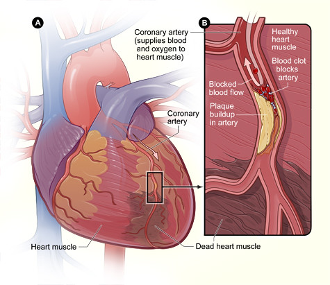 heart with muscle damage